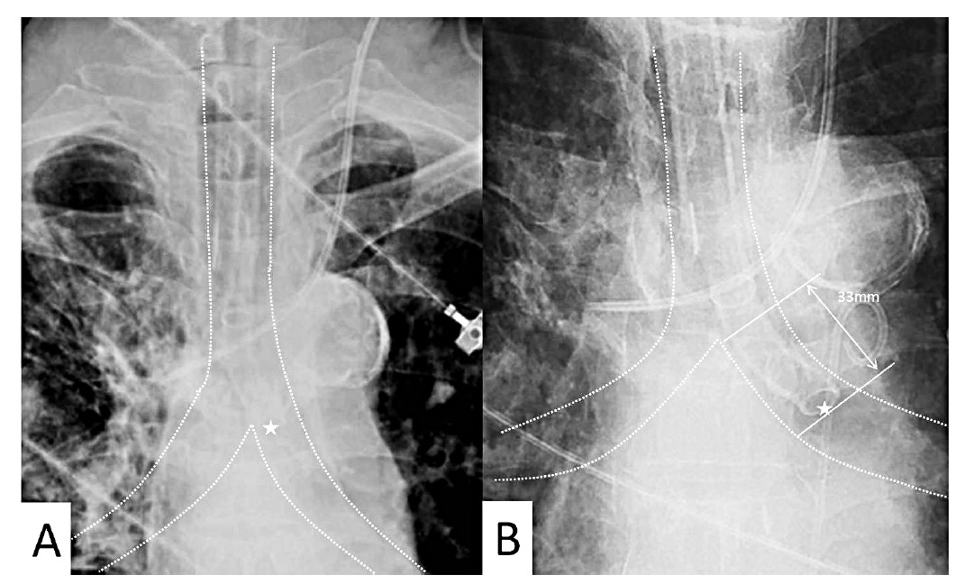 Endotracheal Tube Xray