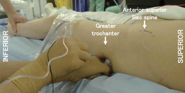 sciatic nerve block anterior approach