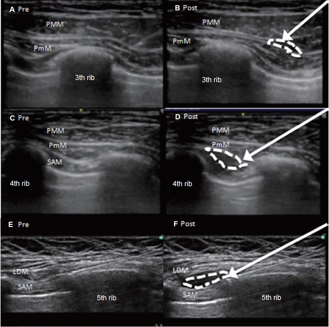 How To Use Pectoral Nerve Blocks Effectively An Evidence Based Update Aja Asian Journal Of Anesthesiology